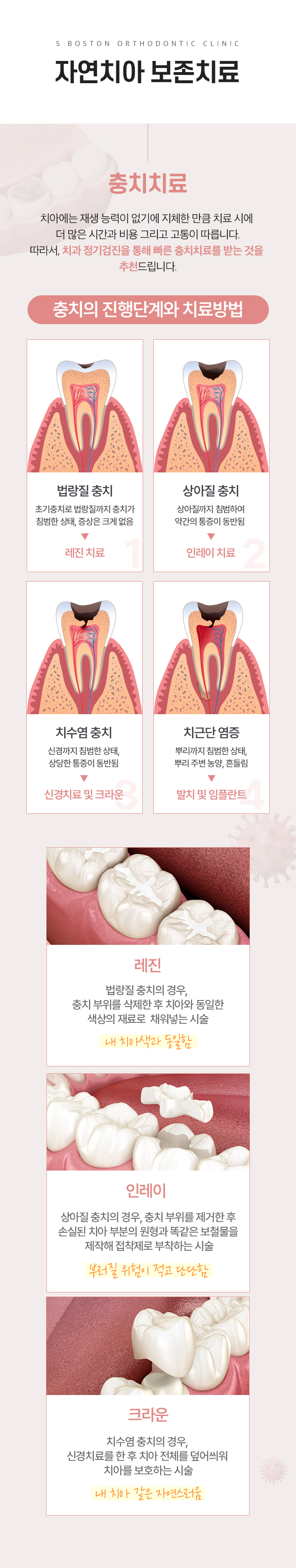 자연치아 보존치료